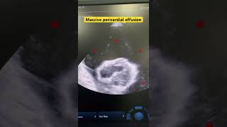 Pericardial effusion Massive  tamponade cardiology clinical heartdisease echocardiography [upl. by Leicam]