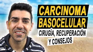 CARCINOMA BASOCELULAR  Operación recuperación y consejos tras tener un carcinoma basal en la cara [upl. by Eusoj]