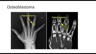 Osteoblastoma [upl. by Yrahca413]