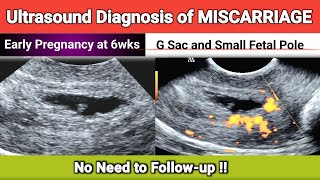 MISCARRIAGE at 6wks  No Need to Followup [upl. by Johathan]