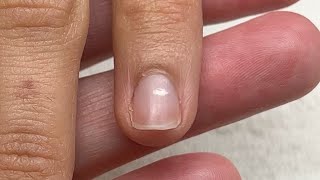 What is happening with this nail Punctate Leukonychia [upl. by Englis]