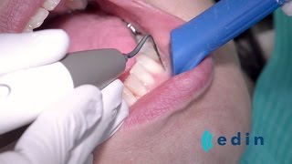 Ultrasoon reinigen bij parodontitis  Edin Dental Academy [upl. by Flora]