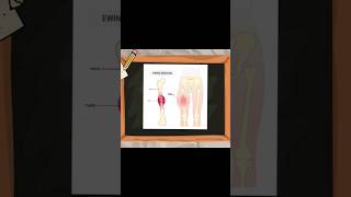 Ewing Sarcoma Common Locations ewingsarcoma ewing sarcoma ortholectures orthopaedics [upl. by Alison232]