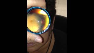 Inexpensive Telemedicine Fundoscopy performed using an Iphone and a 20D lens [upl. by Aisyle]