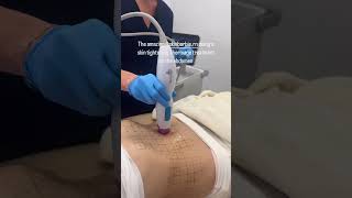 Skin tightening with Thermage thermage collagen skincare [upl. by Fabrianne355]