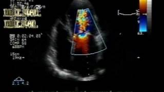 MS different aspectsmitral stenosis with leaflets borders calcification [upl. by Ednalrym]