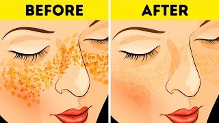 How to Get Rid of Acne Scars In Just 3 Days [upl. by Olodort]