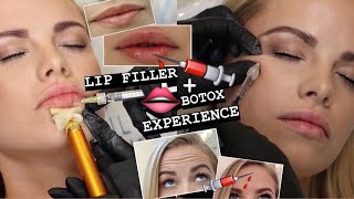 LIP FILLER  BOTOX EXPERIENCE  procedure recovery before and after [upl. by Ibrik]