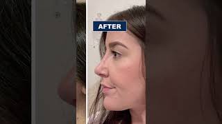 Rhinoplasty Before and After  Nose Job in Turkey  Rhinoplasty Surgeon [upl. by Selin]