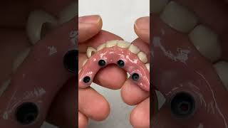 Single Fix capping  Mahi Dental Clinic  Dr Mandeep [upl. by Nafis]