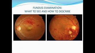 Fundus examination Volk lens direct ophthalmoscopy and binocular indirect ophthalmoscopy [upl. by Nester]