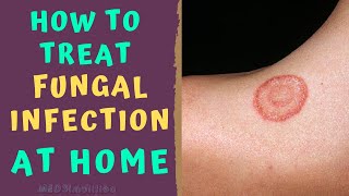 HOW TO TREAT SKIN FUNGAL INFECTION INFECTION AT HOME TINEA RINGWORM REMEDIES HOW TO CURE [upl. by Eanrahs]