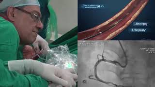 Transradial IntraVascular Lithotripsy Shockwave IVL at CIMS Hospital [upl. by Vera]