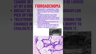 Fibroadenoma pathologyacademy draditikumar mbbs neet neetpg [upl. by Shell]