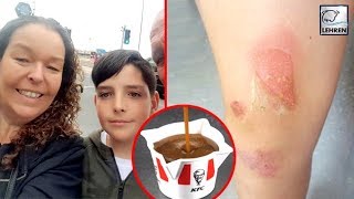 KFCs Chicken Gravy Causes Serious Burns After It Spills On A 10YrOlds Leg  Lehren News [upl. by Aznerol]