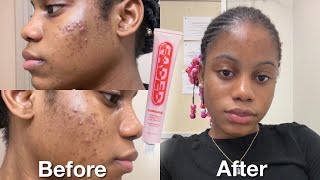 I Tried topicals faded serum for 2 weeks for dark spots amp hyperpigmentation [upl. by Galligan]