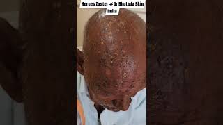 Herpes Zoster Dr Bhutada Skin India [upl. by Negah]