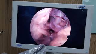 Endoscopic Transorbital Approach [upl. by Pickering]