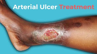 What Are Arterial Ulcers Arterial Ulcer Treatment [upl. by Leibman996]