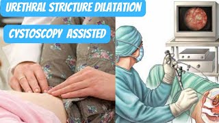 URETHRAL STRICTURE DILATATION USING CYSTOSCOPY [upl. by Abehsat196]