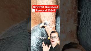 Stunning HUGE BLACKHEAD REMOVAL  Biggest Blackhead 2024 shorts [upl. by Welles398]