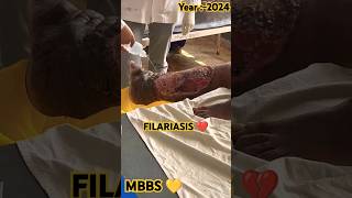 🧑🏻‍🔬FILARIASIS 💔mbbsdoctorfilariasisjoharimbbsneetmbbmbbsdairiesdiseasecancerlifestylepw🪷 [upl. by Warren]