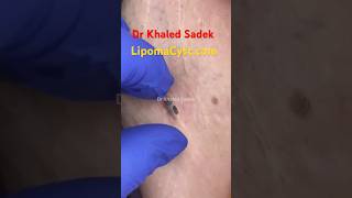 Massive blackhead extraction Dr Khaled Sadek blackheadremoval blackheads skincare [upl. by Lombardi685]