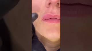 Dissolving Using Hyalase Dermal Fillers Lip Fillers [upl. by Isidoro279]