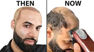 I Shaved My HEAD BALD 4 Years After Hair Transplant  Surgeon Reacts [upl. by Noda]