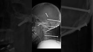 IIsidro Mejia a construction worker had six nails embedded in his skull after a nail gun accident [upl. by Nnaasil]