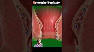 remove hemorrhoids laser 3danimationsurgery crazypharmaguruji1331 goodtoknow [upl. by Jacey]