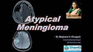 Atypical Meningioma [upl. by Remled]