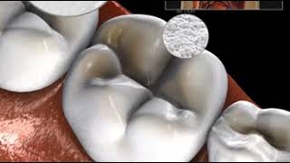 Filling Occlusal Air Abrasion [upl. by Yderf]