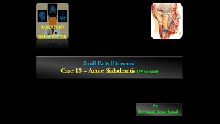 Ultrasound Case 13  Acute Sialadenitis Web case [upl. by Eimmelc]