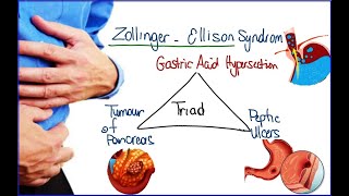 Zollinger ellison syndrome Gastrinoma in the pancreas caused by Multiple endocrine neoplasia type 1 [upl. by Aramoj]