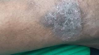 Leech bite eczema [upl. by Kassity]