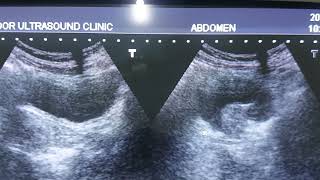 ultrasound pelvis ultrasound Fallopian Tubes hydrosalpinx [upl. by Nitsoj467]