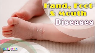 Hand Foot and Mouth Disease  Treatment of Hand Foot amp Mouth Disease Treatment and When to Worry [upl. by Enilegnave47]