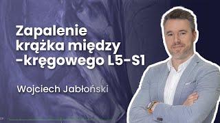 Zapalenie krążka międzykręgowego L5S1  25 Radiologia [upl. by Lanford635]