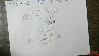 Upper and lower motor neuron type of facial palsy [upl. by Meredith]