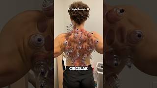 Cupping Therapy 😨 EXPLAINED [upl. by Madeline]