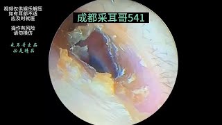 Thin film on the eardrum cerumen embolism ｜541 [upl. by Alec76]