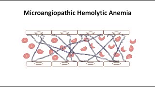 Microangiopathic Hemolytic Anemia [upl. by Lorelle797]