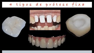 Prótese Fixa  4 tipos diferentes [upl. by Xer]