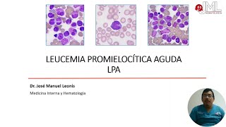 LEUCEMIA PROMIELOCÍTICA AGUDA APRENDIZAJE BASADO EN CASO CLÍNICO PARTE 1 [upl. by Krute854]