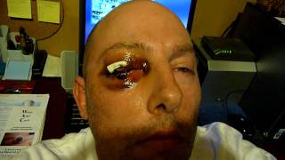 3 Days After My Eye Removal Surgery ENUCLEATION [upl. by Otinauj293]