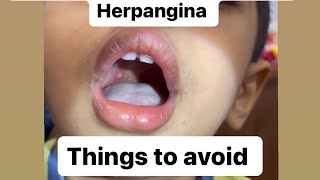 Hand foot and mouth disease  HERPANGINA most important thing to avoid [upl. by Lael625]