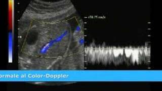 MED2000ECO Persistenza della Vena Ombelicale Destra [upl. by Nairahcaz]