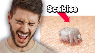 Scabies  Pathogenesis Transmission Signs amp Symptoms Risk Factors Diagnosis amp Treatment [upl. by Nnek371]