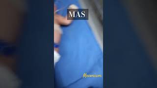 MAS Meconium Aspirated Syndrome meconium syndrome aspiration ytshorts ytfeed nursingofficer [upl. by Uyr]